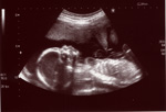 20 week scan of the Worrybomb